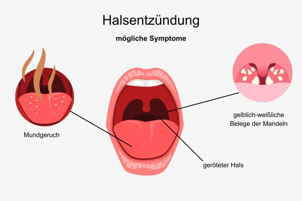 Halsentzündung Pharyngitis Symptome - ©Canva
