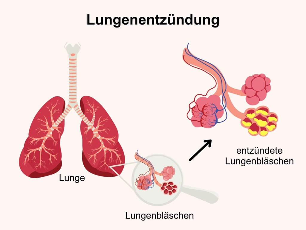 Entzündeten Lunge, Lungenentzündung, Pneumonie - © Canva