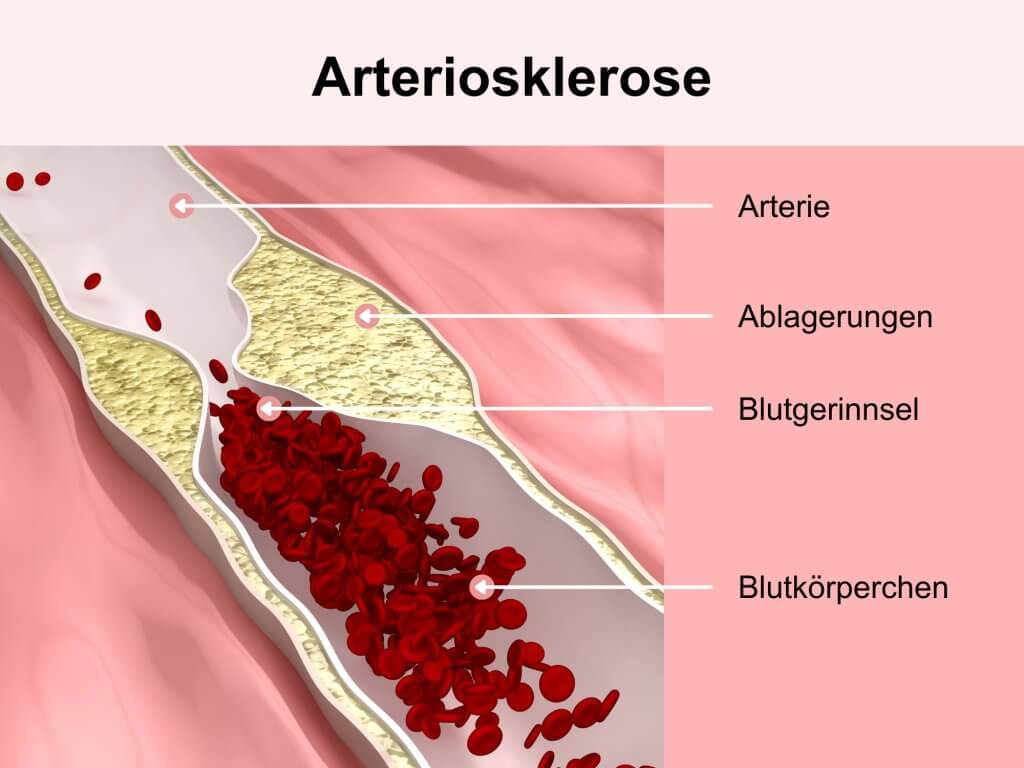 Arteriosklerose, Gefäßverkalkung, Arterienverkalkung, verstopfte Arterien - © Canva